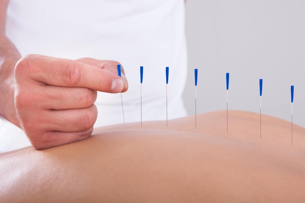 Acupuncture Suffolk County