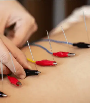 Close-up of a person's back undergoing electroacupuncture treatment at Acupuncture Long Island. Several acupuncture needles are inserted into the skin with colored electrical clips (red, black, yellow, blue) attached to them. A practitioner's hand is adjusting one of the needles.