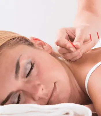 A woman with closed eyes is lying on her stomach, receiving an Acupuncture Long Island treatment. Several thin needles are inserted into the skin around her neck and shoulder area, while a practitioner's hand is visible adjusting one of the needles.