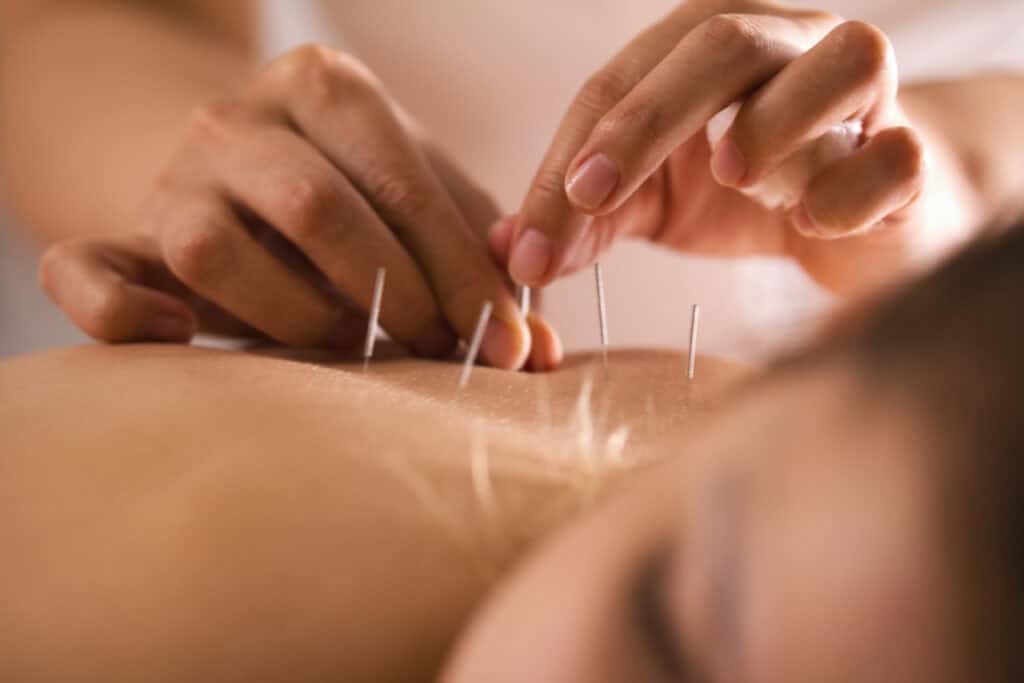 Close-up of a person receiving acupuncture treatment in Long Island. The practitioner's hands are seen inserting thin needles into the person's back. The person's face is partially visible, and they appear relaxed and lying down. The atmosphere seems calm and focused, ideal for effective pain management.