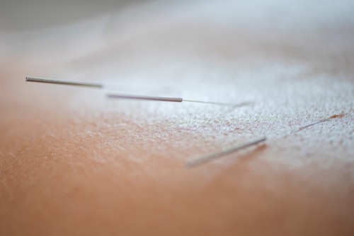 Close-up of acupuncture needles inserted into a person's skin, with a shallow depth of field blurring the background. The thin, metallic needles are expertly positioned, suggesting a professional Acupuncture Long Island session.