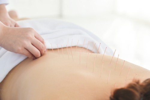 Row Of Needles On Patient Back Who Receiving Accupuncture Therapy