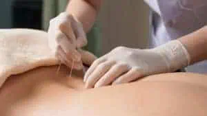 A practitioner wearing gloves is performing acupuncture on a person's back, carefully inserting thin needles into the skin while a towel rests over the person's upper back and shoulders. The scene is set in a clinical or therapeutic environment, specializing in Pain Management Long Island.