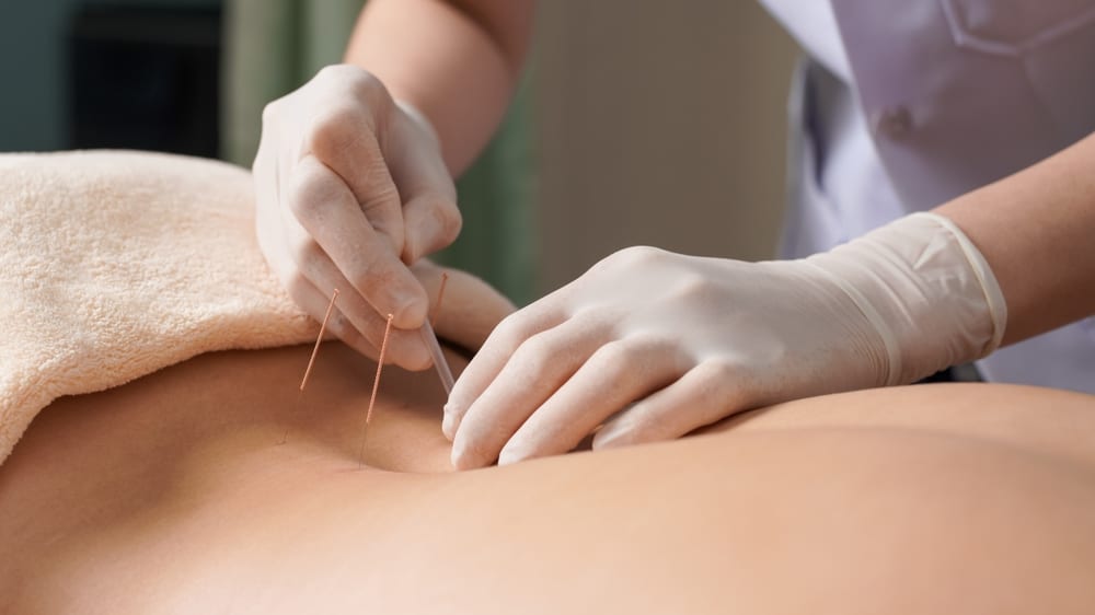 Acupuncture For Woman Back To Relieve Pain.