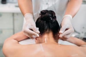 A person lying face down receives acupuncture therapy. An acupuncturist, wearing gloves, carefully inserts thin needles into the person's upper back and neck area. The room is clinical and clean, suggesting a professional environment, typical of Pain Management Long Island clinics.