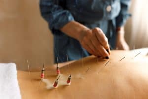 A person is receiving Acupuncture Long Island therapy, lying face down with several thin needles inserted into their back. A practitioner in a blue outfit is holding an instrument near the needles, which have visible smoke emanating from them.