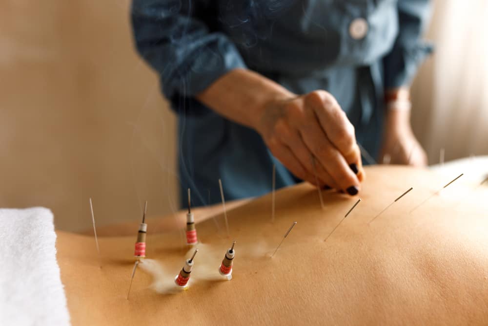 acupuncturist applying treatment to a persons back
