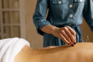 A person in a blue coat administers acupuncture to the exposed back of another, demonstrating Acupuncture Long Island practices. Several thin needles are inserted into the patient's back, and a white towel covers the lower part of their body. The practitioner's hand hovers over the needles.