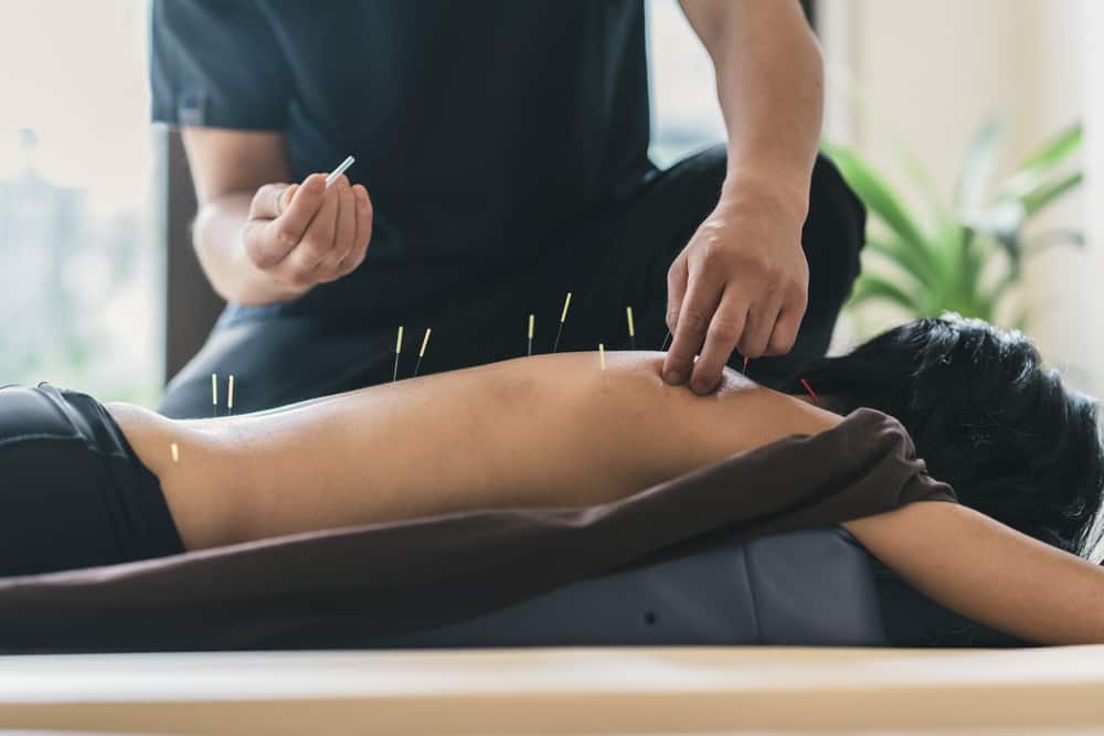 A person lies face down on a table receiving acupuncture treatment. A practitioner is seen inserting thin acupuncture needles into the person's bare back. The setting, typical of Acupuncture Long Island, appears to be a calm, indoor environment with soft lighting.