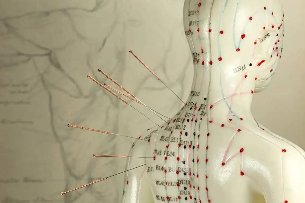 A model of a human back with acupuncture needles inserted at various points. The model shows acupuncture meridians and pressure points marked with red dots and lines. The background contains anatomical illustrations, highlighting the practice of Acupuncture Long Island for holistic healing.