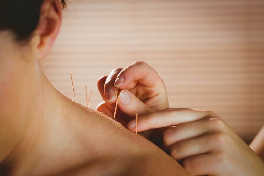A close-up of a person receiving acupuncture on Long Island. Four thin needles are inserted into the upper back, close to the shoulder blades. A practitioner's hands are delicately handling one of the needles while the background is softly blurred with warm tones.