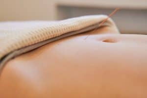 Close-up of a person's abdomen with an acupuncture needle inserted into the skin. Part of the person's body is covered by a white towel. The background is blurred, drawing focus to the needle and the skin.