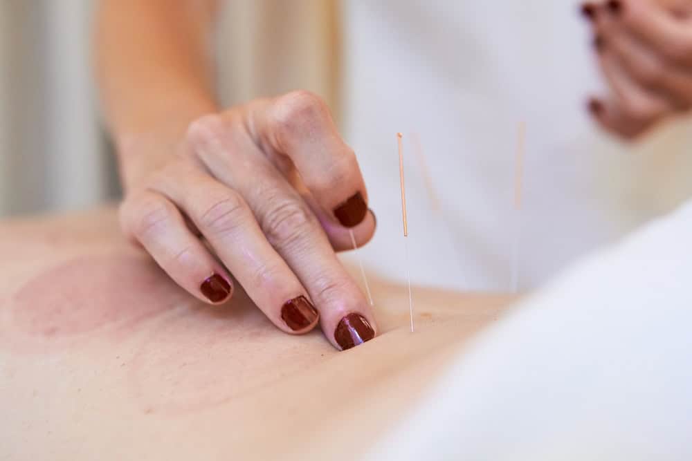 Close-up of a person's hand with dark red nail polish inserting acupuncture needles into a patient's bare back. The skin has a few red marks, likely from previous treatment. The scene appears to be in a clinical or wellness setting.
