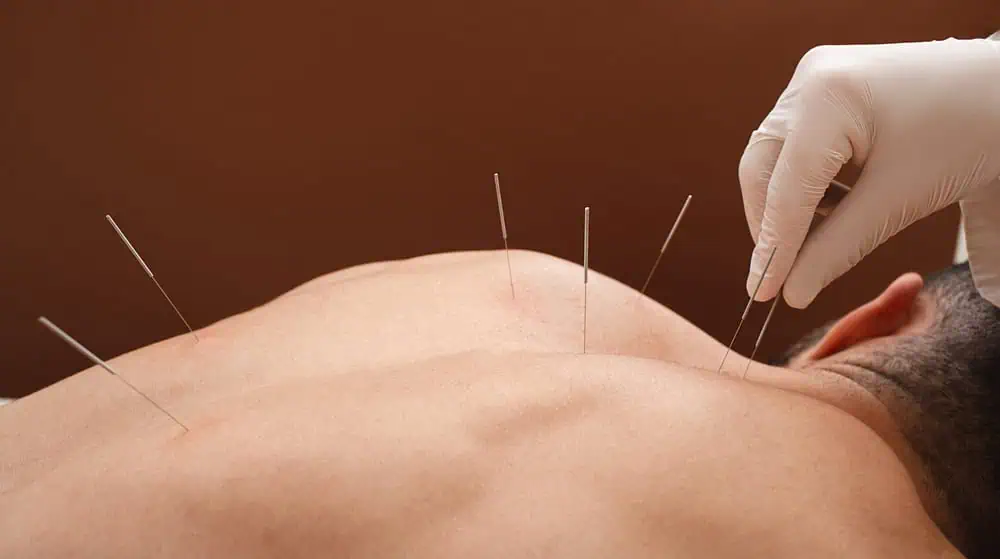 A person receiving acupuncture treatment, shown lying face down with several thin needles inserted into their back. A practitioner wearing a glove is visible adjusting one of the needles.