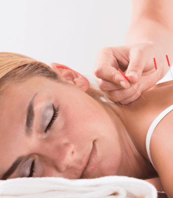 A woman with closed eyes is lying on her stomach, receiving an Acupuncture Long Island treatment. Several thin needles are inserted into the skin around her neck and shoulder area, while a practitioner's hand is visible adjusting one of the needles.
